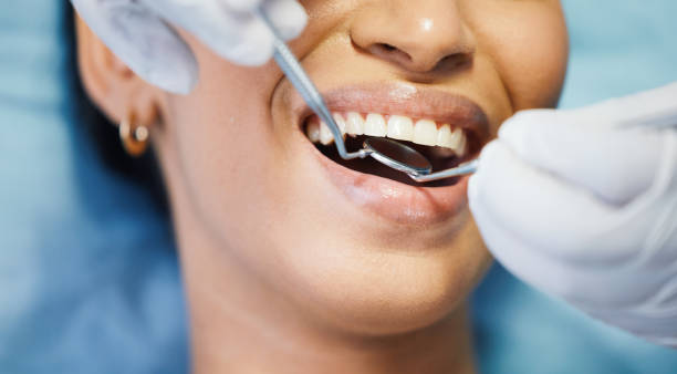 Best Emergency Wisdom Tooth Extraction in Bertram, TX